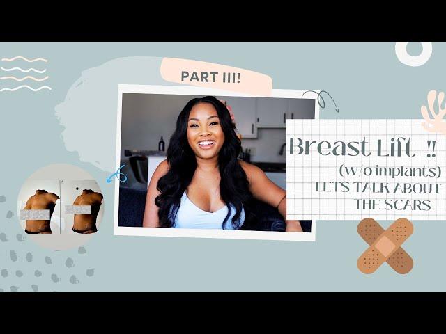 Breast lift w/o implants: Chit chat & SEE MY SCARS