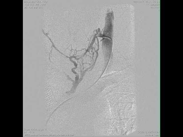 venous hypertension and thyroid