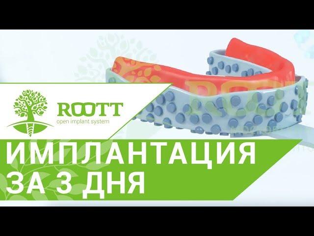 Имплантация зубов верхней челюсти.  Однофазная имплантация зубов верхней челюсти. ROOTT.