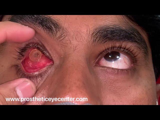 Artificial eye movements| Lost eye treatment| Prosthetic Eye