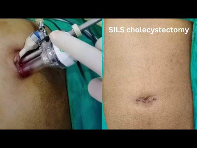 SINGLE INCISION (SILS) LAPAROSCOPIC CHOLECYSTECTOMY