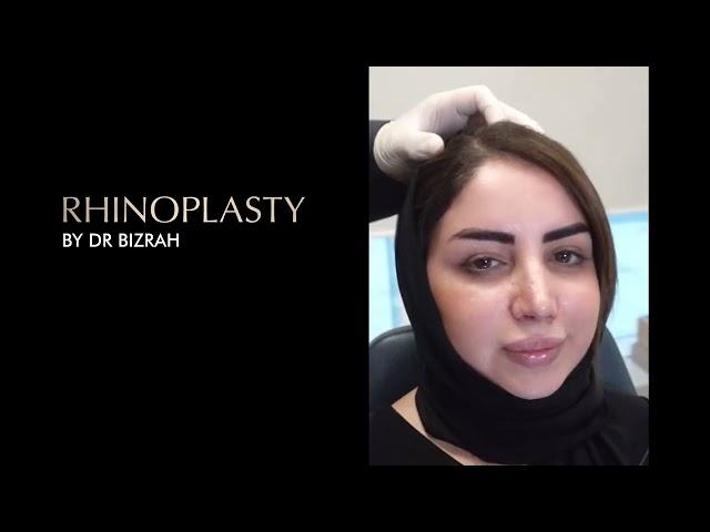 Beyond Beauty: A Patient's Story of Rhinoplasty with Dr. Bashar Bizrah