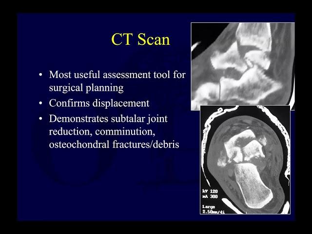 Talus fractures 1 - assessment  (OTA lecture series III l14a)