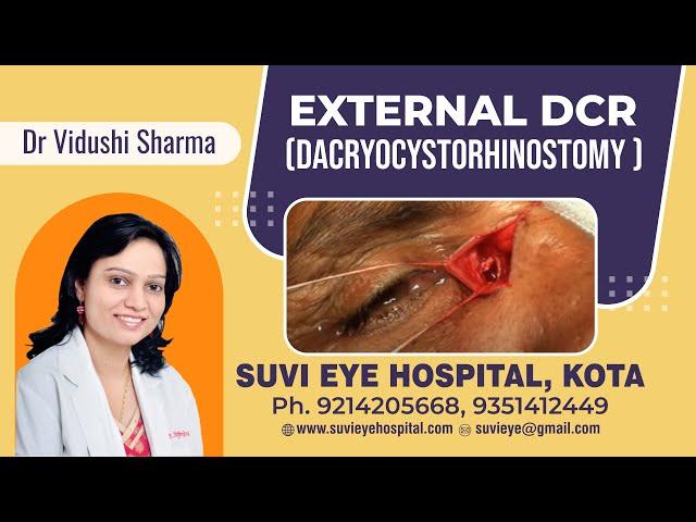 External DACRYOCYSTORHINOSTOMY (DCR) by Dr Vidushi Sharma, SuVi Eye Institute, Kota,  INDIA.mpg