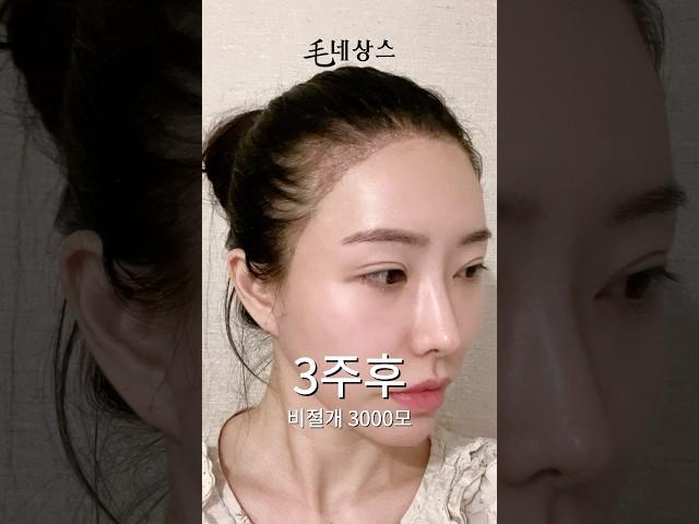 M자 탈모 극복, 얼굴 확 작아진 모발이식 결과 공개!