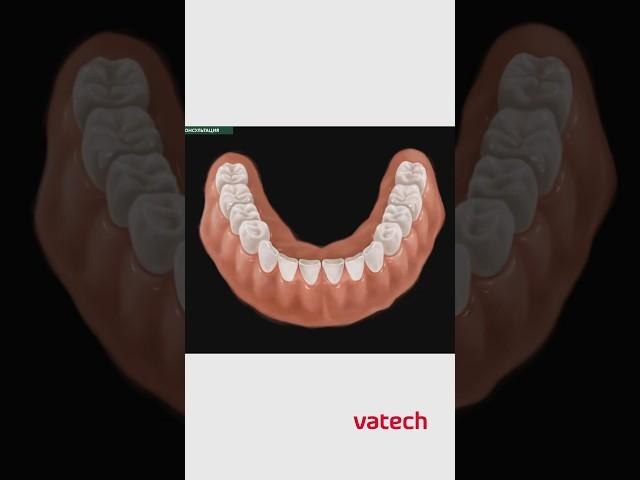Консультация в программном обеспечении EzDent-i #vatech #стоматология #зубы