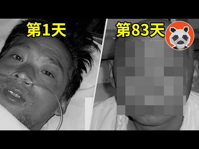 核輻射死亡83天全紀錄，看著自己融化是種什麼體驗？他遭受2萬倍的輻射量，世界上死的最慘的人【熊貓周周】