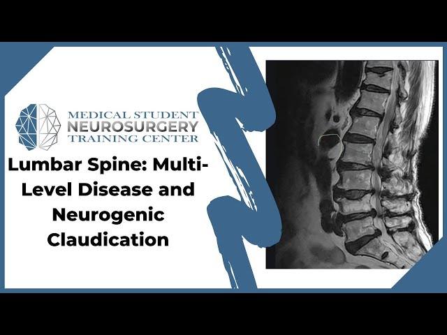 Lumbar Spine: Multi-Level Disease and Neurogenic Claudication