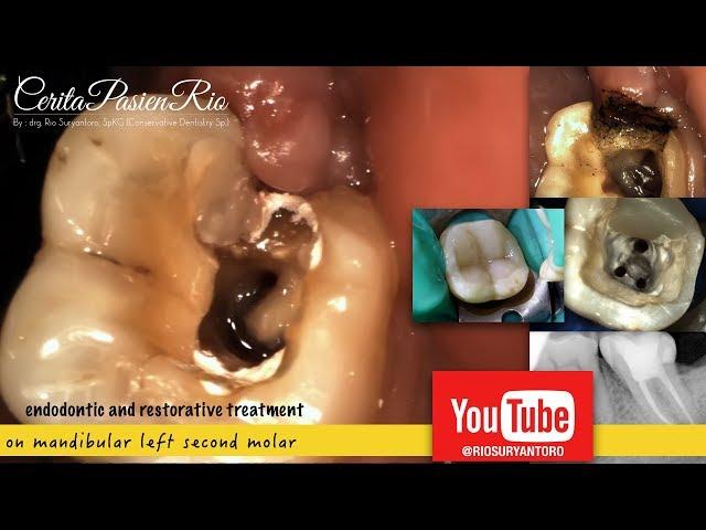 root canal treatment on mandibular molar - perawatan gigi berlubang saluran akar dokter gigi