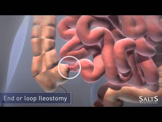 What is an Ileostomy?