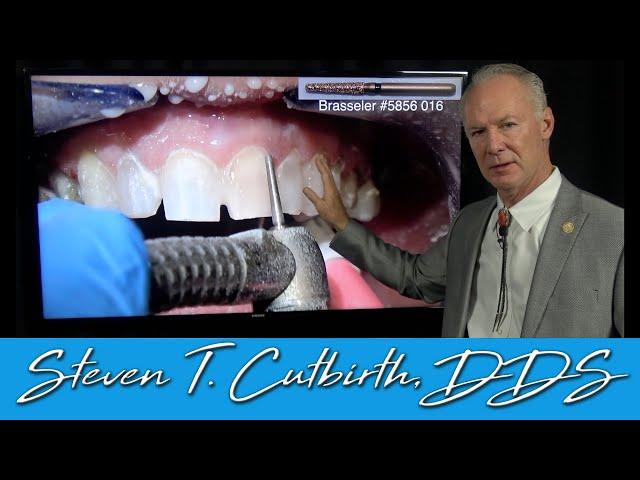 Prepping Maxillary Teeth for Veneers and Crowns - Dental Minute with Steven T. Cutbirth, DDS