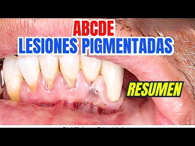 ABCDE de Lesiones Pigmentadas (Resumen)