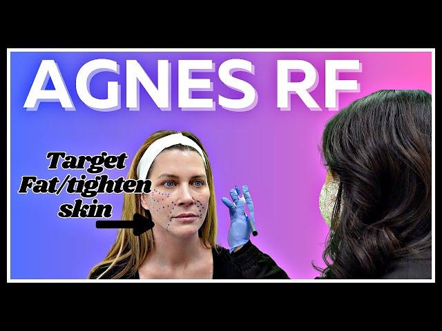 Shrinking Jowls and eye bags with AGNES RF in-office