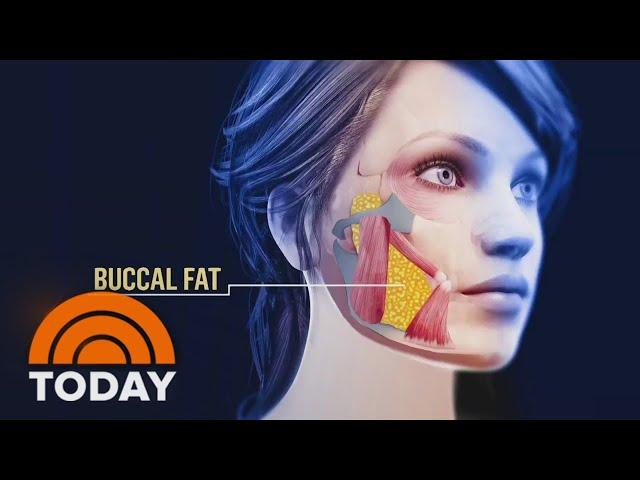 Buccal fat removal: Inside latest trend to reshape the face