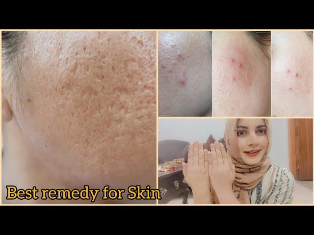 Open pores , Large Pores , Clogged Pores Remedy by momina kiran