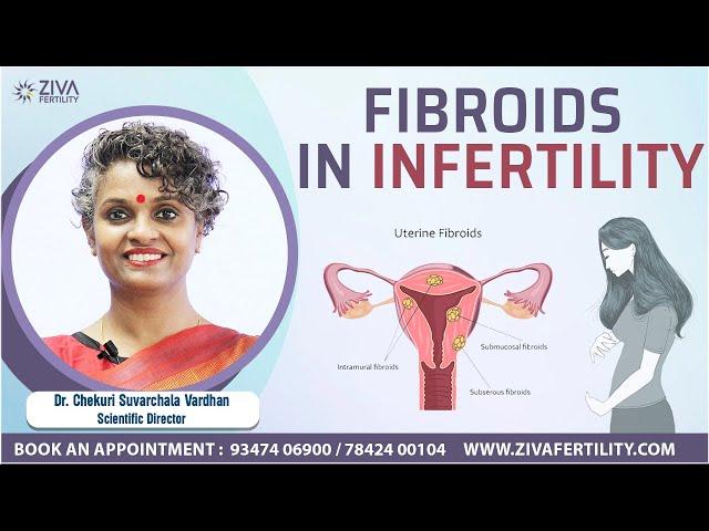 Fibroids in Infertility - ZIVA Fertility English - Dr. Chekuri Suvarchala Vardhan