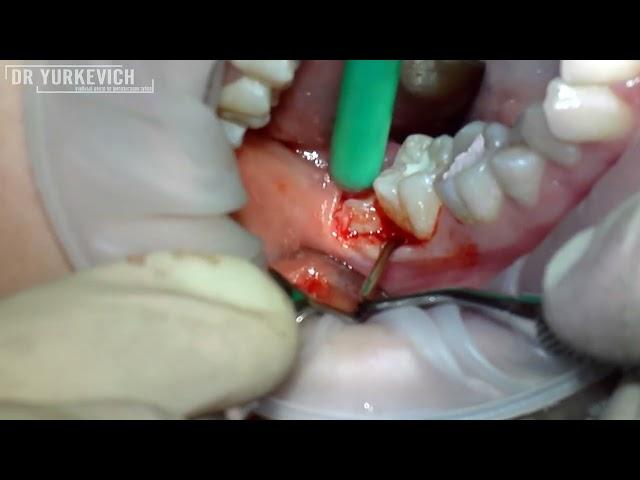 Удаление полуретенированных зубов мудрости. Wisdom teeth extraction