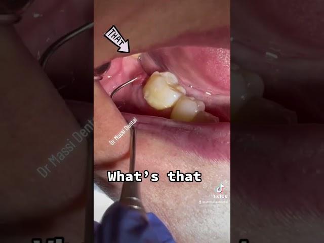 Gum Boil, toot fracture