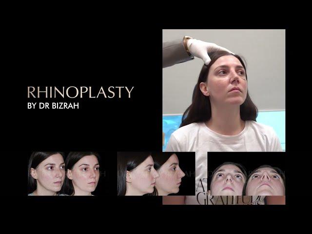  Beyond Beauty: A Patient's Story of Rhinoplasty with Dr. Bashar Bizrah