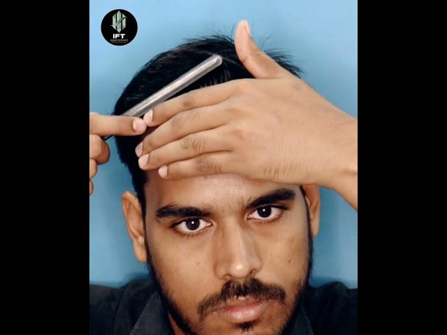 Interlocking Hair Transplant Technique Before & After Result in Hyderabad #hairtransplaninhyderabad