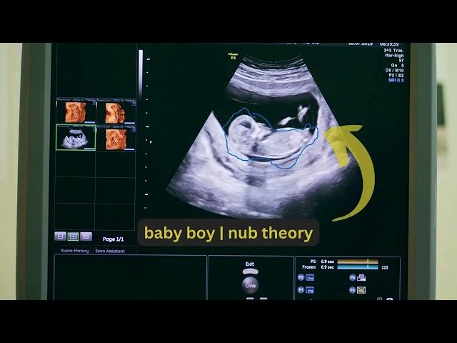 Ultrasound showing baby boy | 3D &  4D | #ultrasound