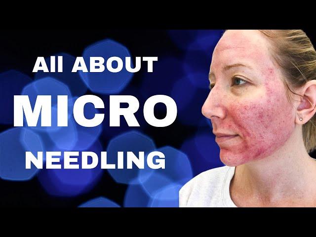 Is Microneedling Worth It , Dr. Messina of Long Island Explains