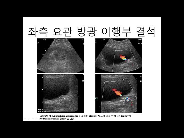 2022-11-9 영남 임상 초음파 연구회 강의, 방광 초음파(2) 김일봉