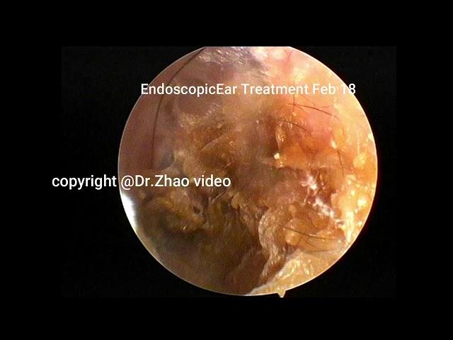 Plain cerumen and external auditory canal cholesteatoma re cleaned, 13 minutes