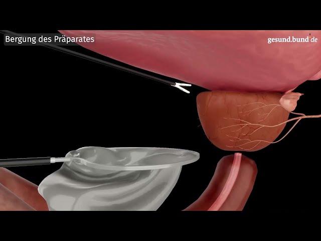 Was ist eine Laparoskopische Prostatektomie?