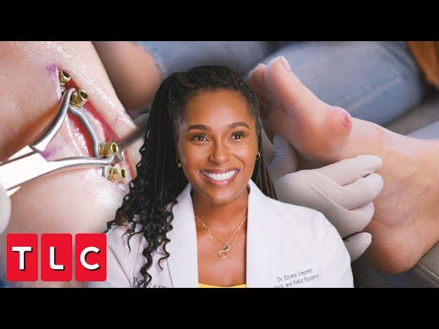 Dr. Ebonie Removes Massive Bunion and Fixes Foot Deformity | My Feet Are Killing Me