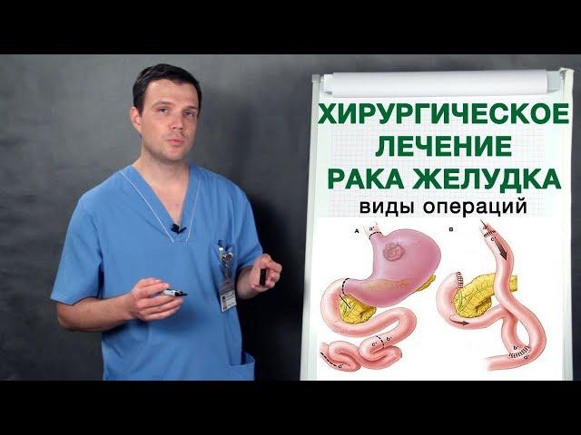 Рак желудка - хирургическое лечение рака желудка. Врач-онколог Владимир Лядов.