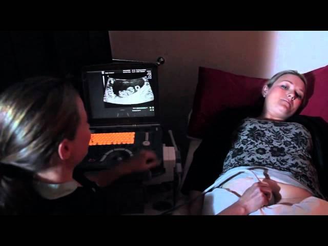 Early Pregnancy Scan