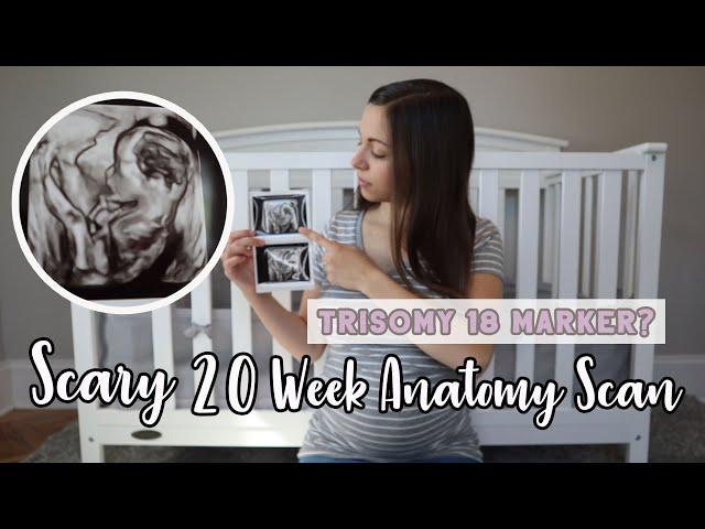 Scary 20 Week Anatomy Scan | Trisomy 18 Marker?