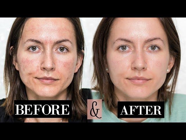 My MICRONEEDLING Experience| + Skin Updates | Before & After