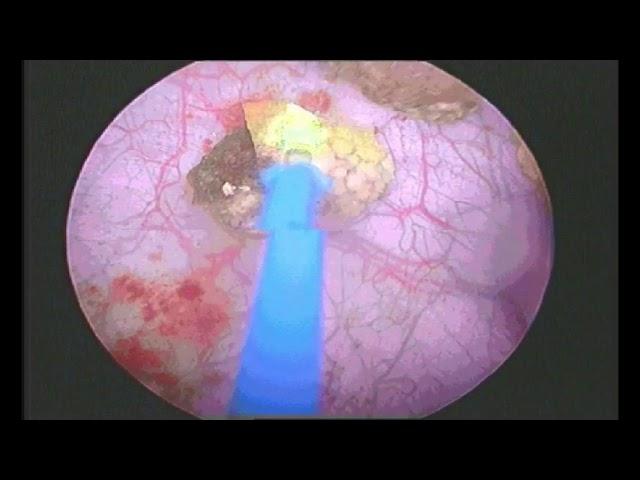 Urinary bladder Stone By Laser