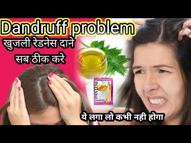 Dandruff Clean Karen 10 Minut Mein||डैंड्रफ कैसे ठीक करें होमरिमेडी सिर्फ 10 मिनट में ठीक करें