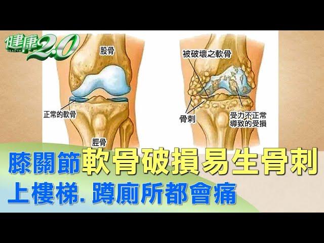 膝關節軟骨破損易生骨刺 上樓梯、蹲廁所都會痛 健康2.0