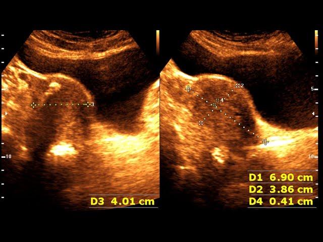 Fatty Liver | Cholelithiasis | Post Covid UTI