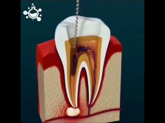 animated root canal treatment demo #rootcanaltreatment #rct #rootcanalspecialist #endodontic