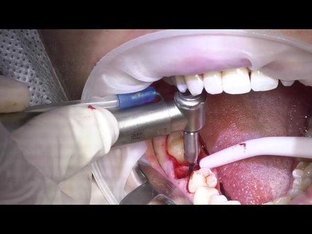 Видео операции Максима Хышова. Атравматичное удаление зуба и установка имплантата Renovа.