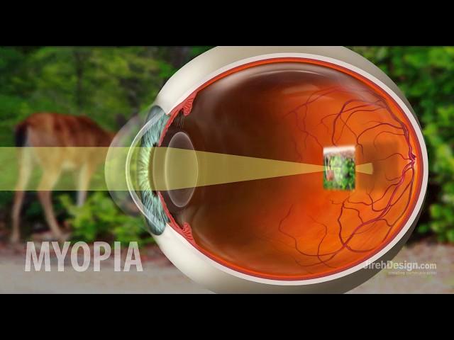 Myopia | Nearsightedness explained [HD]