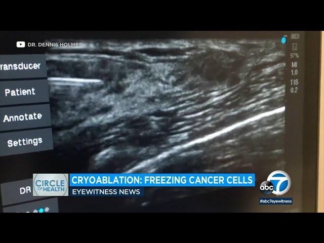 Freezing away earlier stages of breast cancer? How Cryoablation could be all a patient needs