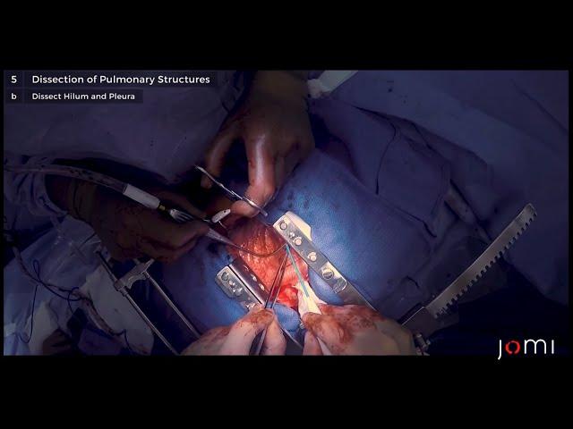 Open Lobectomy (Links to Full Procedure)