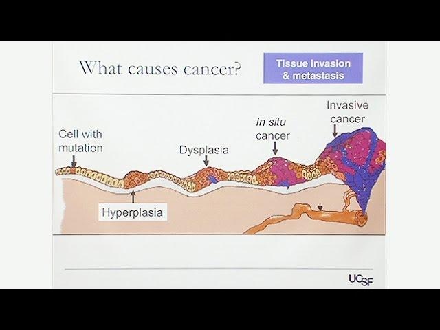 Overview of Gynecologic Cancers