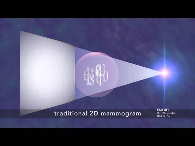 Tomosynthesis / 3-D Mammogram a New Breast Imaging Technique