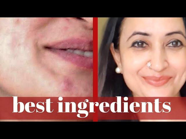 Ingredients For Acne Prone Skin