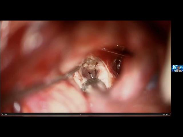 Surgery for Brainstem Cavernous Malformations by Michael Lawton MD of Barrows Neurological Institute