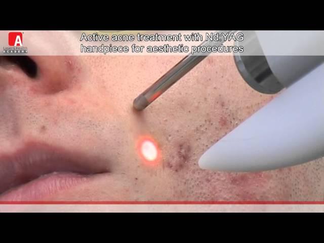 ACNE VULGARIS TREATMENT Fotona Lightwalker Nd:YAG laser