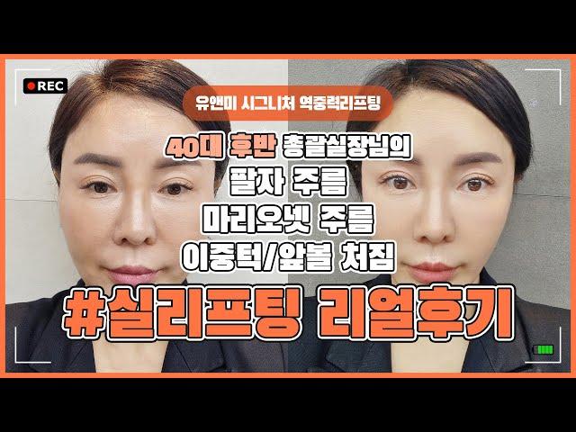 [리얼후기 ]  40대실리프팅  /  마리오넷리프팅   /  이중턱리프팅   /  앞볼실리프팅 / 시술 후기