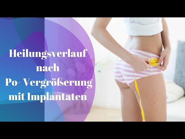 Gesäßaugmentation/ Po-Vergrößerung mit Implantaten / Brazilian Butt Lift - die komplette Operation